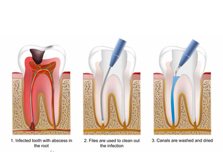 Conventional Root Canals