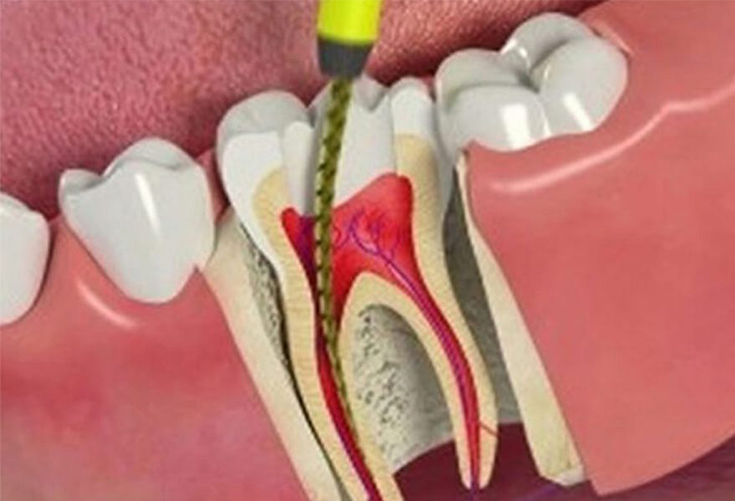 Molar Root Canal Treatment