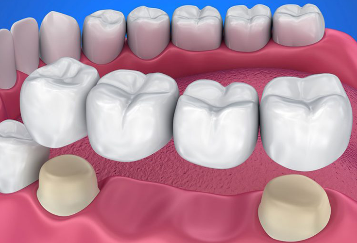 Multiple teeth replacement with Long Bridges