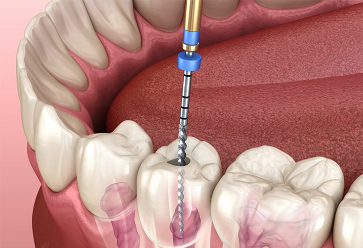 Pre-Molar Root Canal Treatment