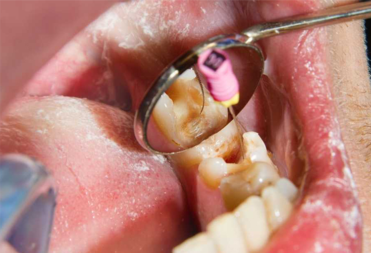 Re-root Canal Treatment