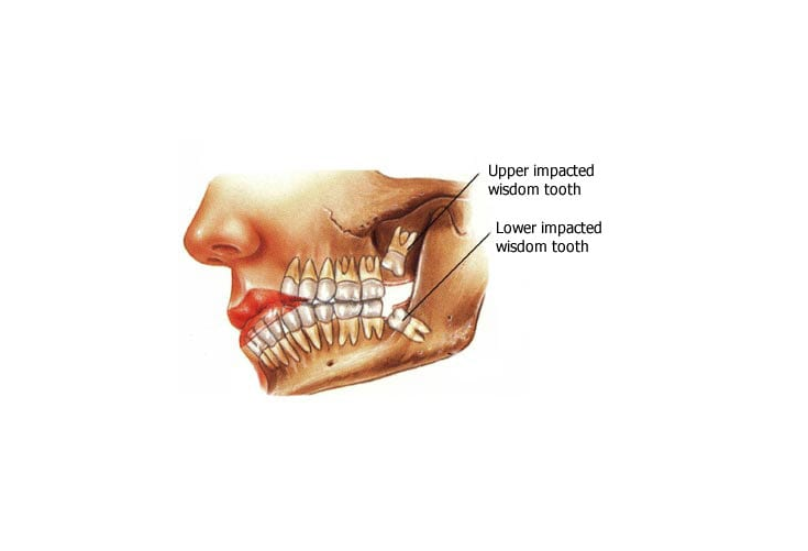 Complicated Wisdom Tooth Extractions / Impactions