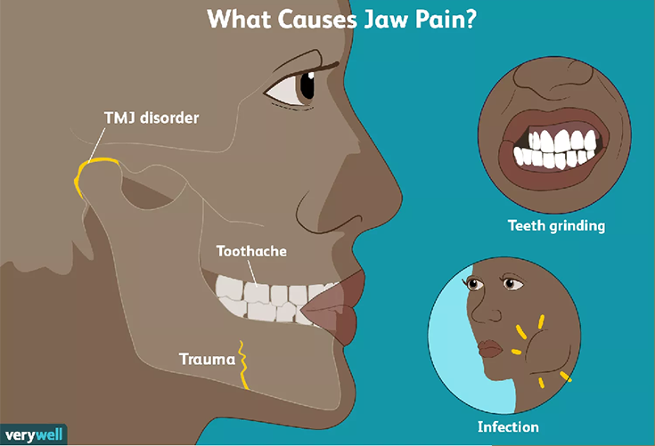 Myofascial Pain Management / TMJ Pain (Jaw pain) in Dubai