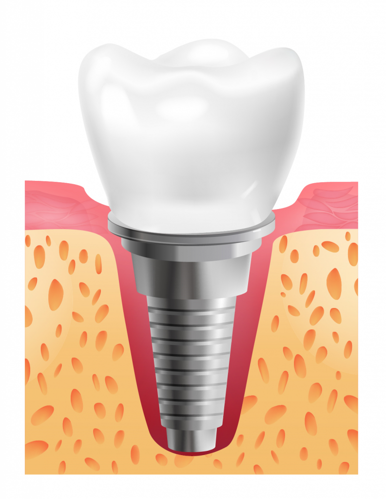 Dental Implant cost in Dubai