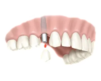 INGLE-TOOTH IMPLANT