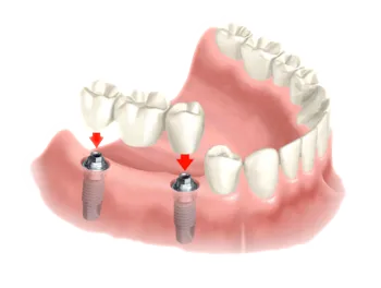dentalimplant bridge